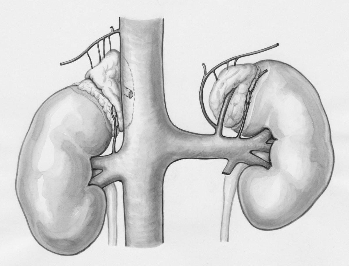 Diagram showing how excess iron causes oxidative stress in dog kidneys via Fenton reactions, leading to tubular necrosis and inflammation